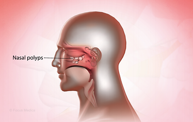 What are nasal polyps?